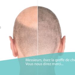 Implant capillaire