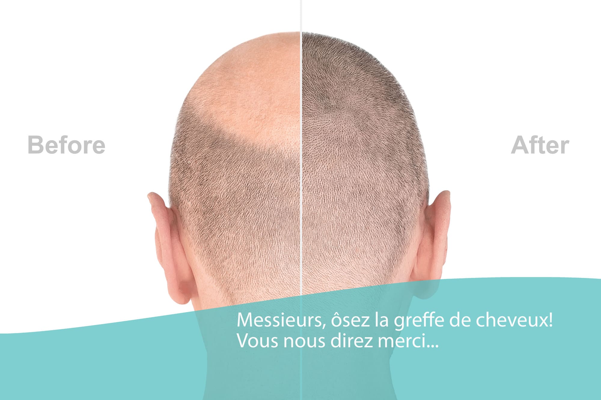 Implant capillaire
