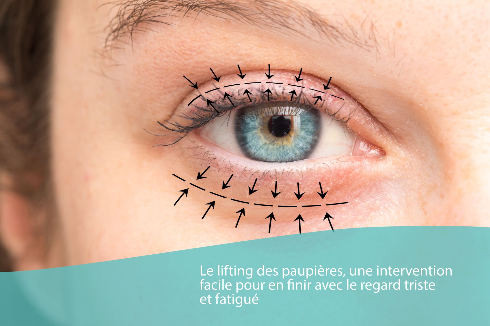Blépharoplastie