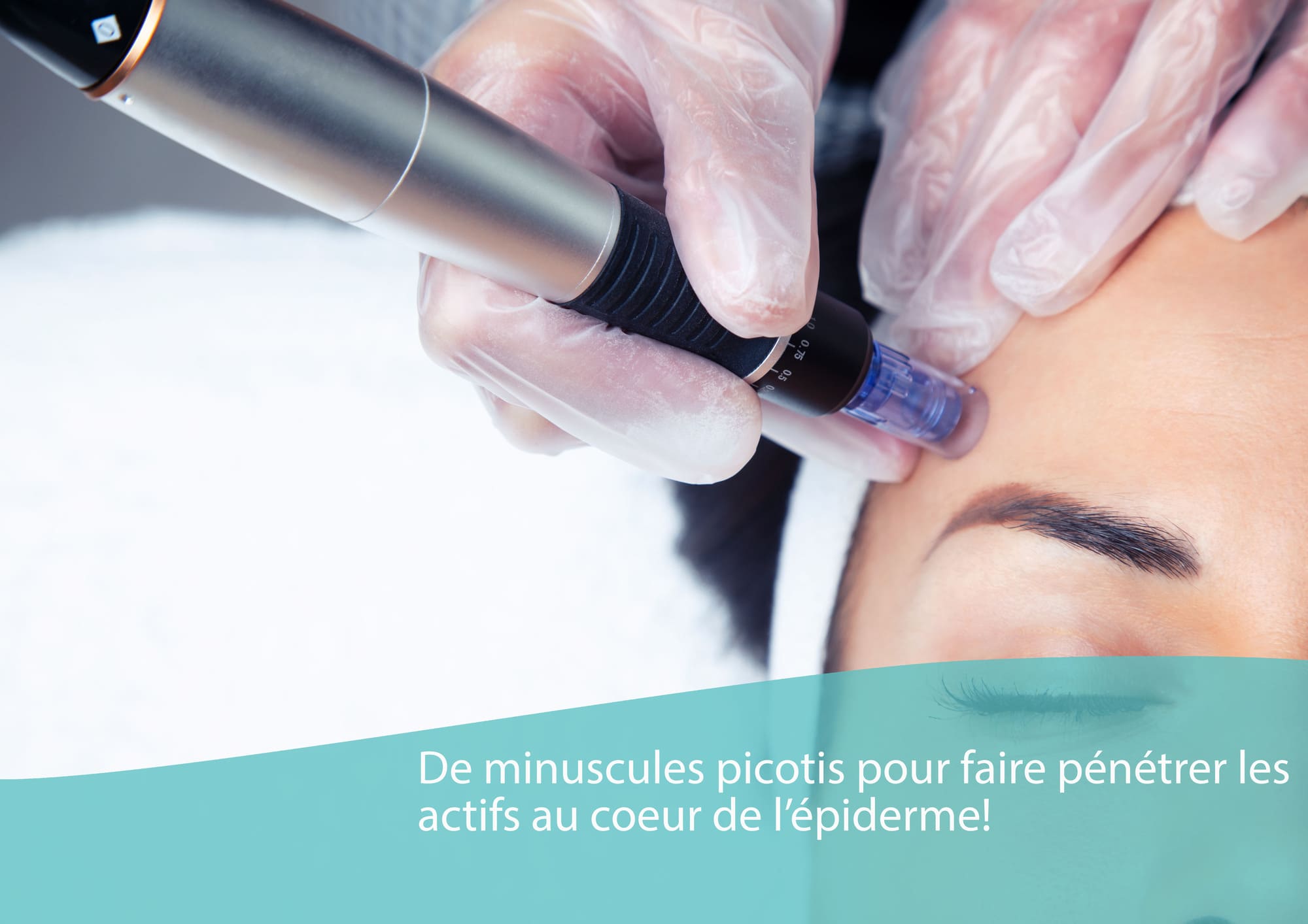 Microneedling