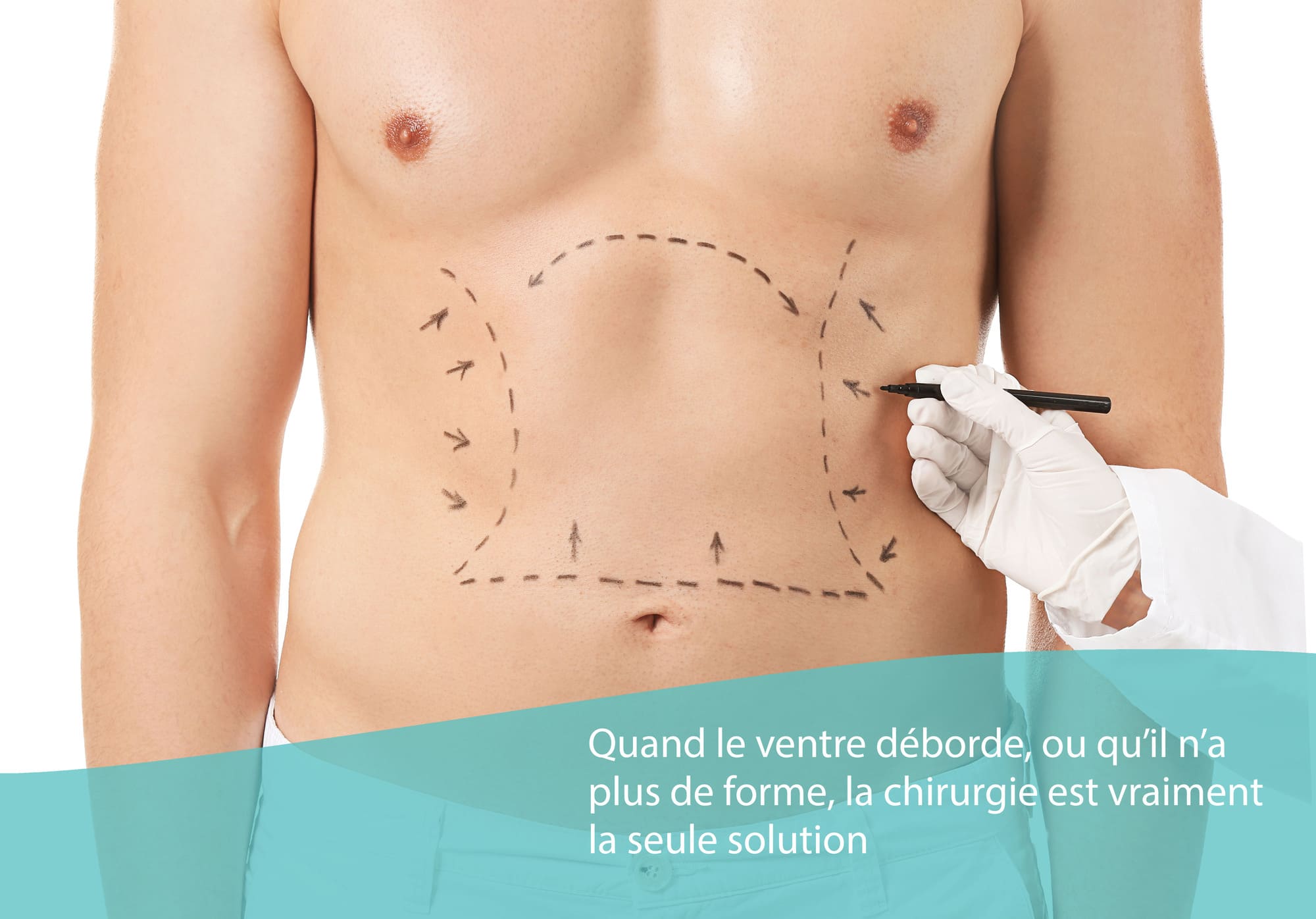 Abdominoplastie
