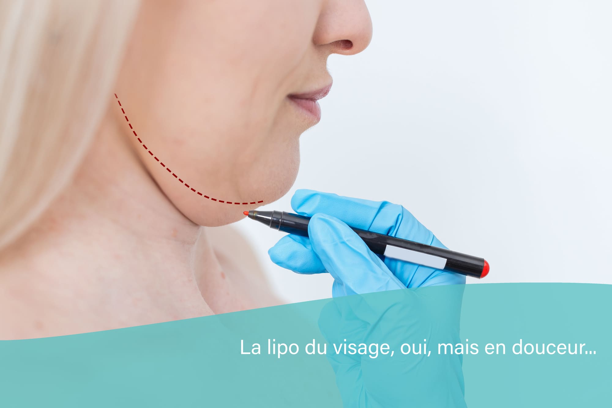 Liposuccion douce ovale du visage