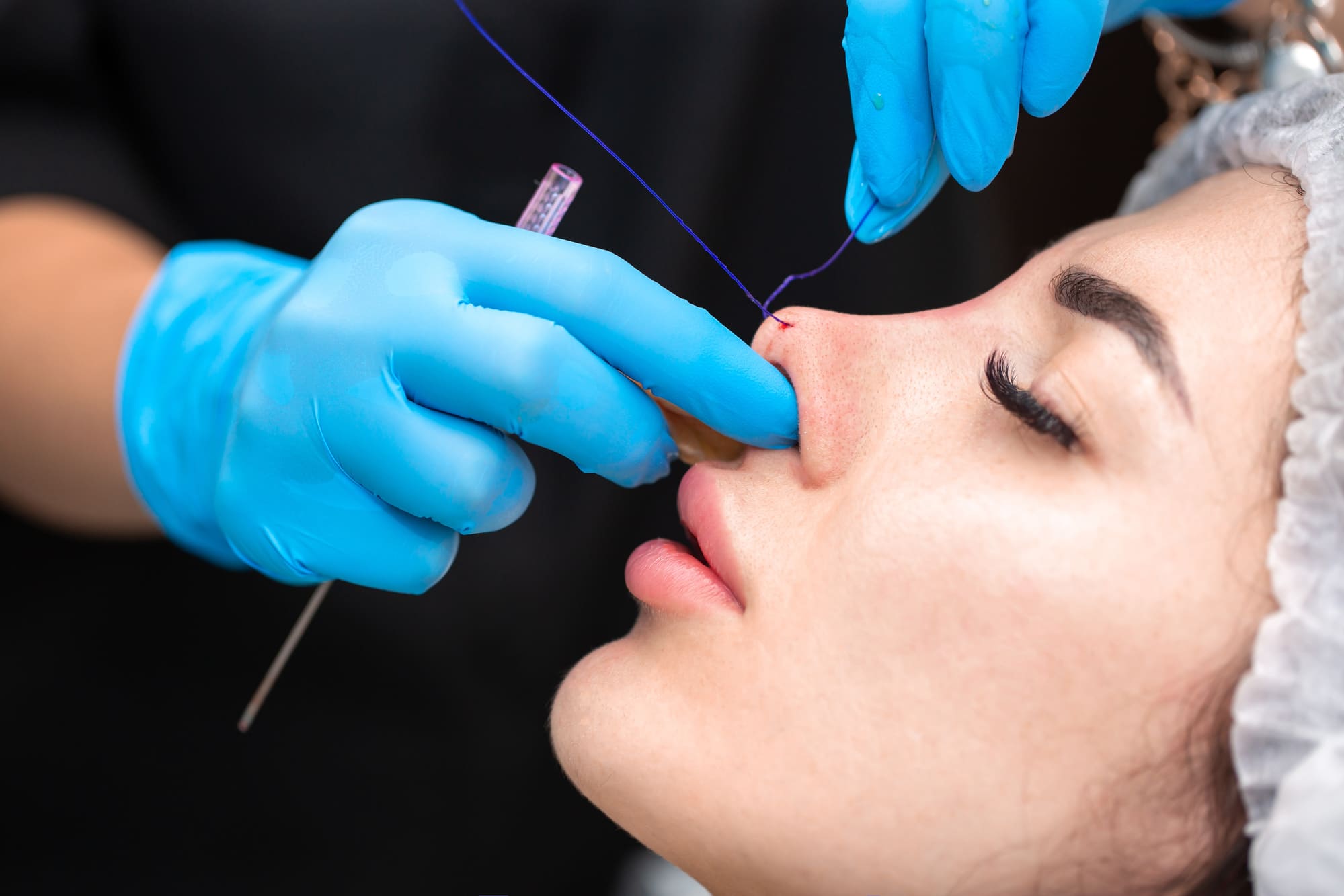 Rhinoplastie