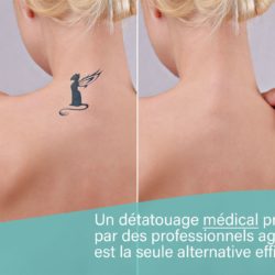 Détatouage