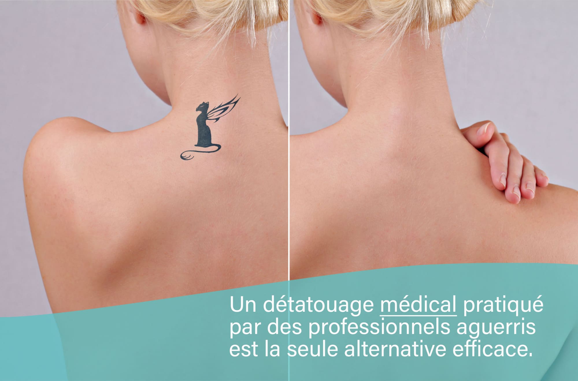 Détatouage