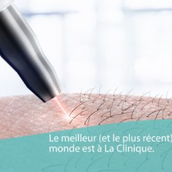 Épilation laser