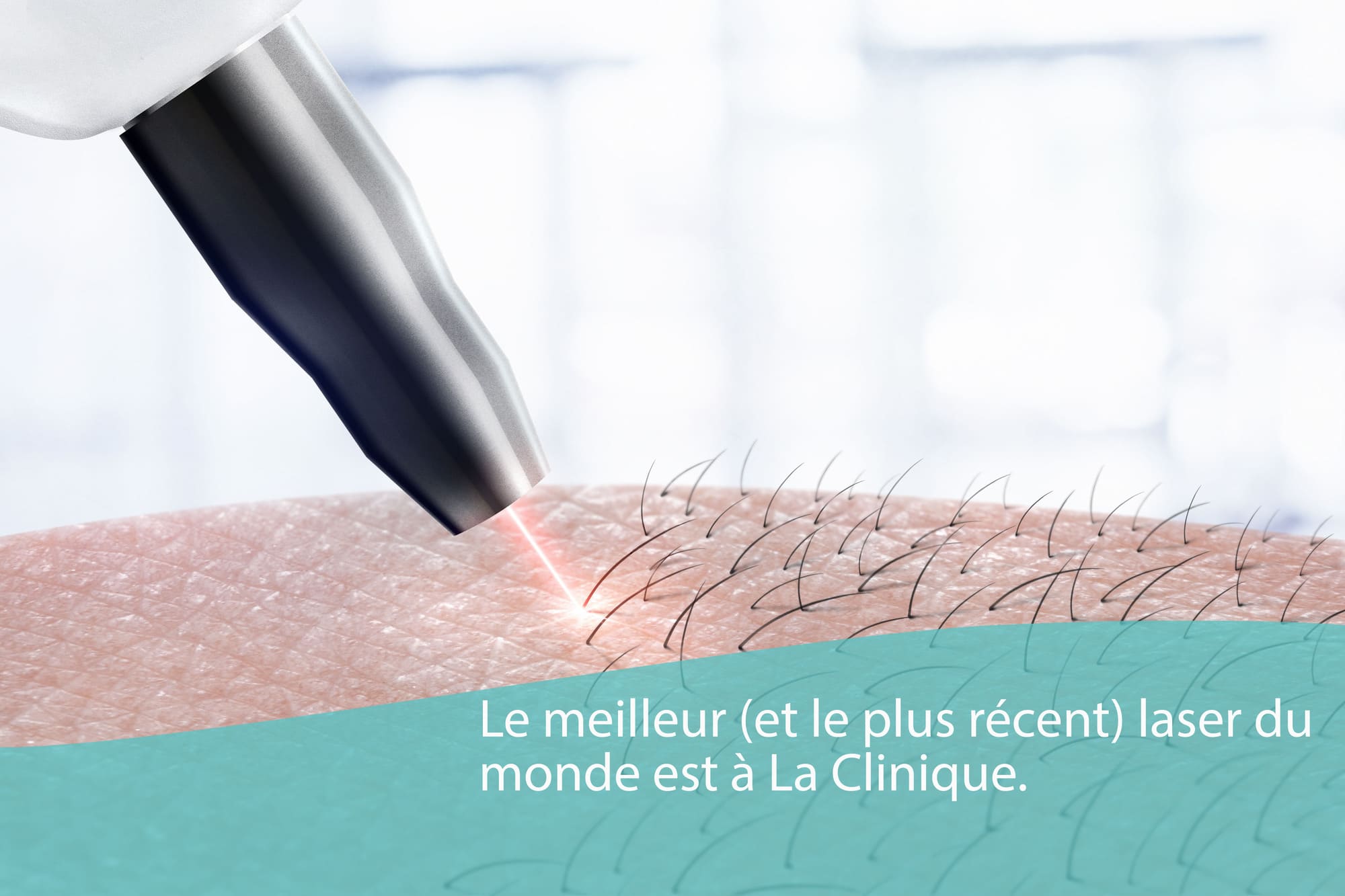 Épilation laser