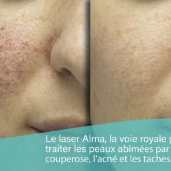 Couperose – Tâches pigmentaires – Acné