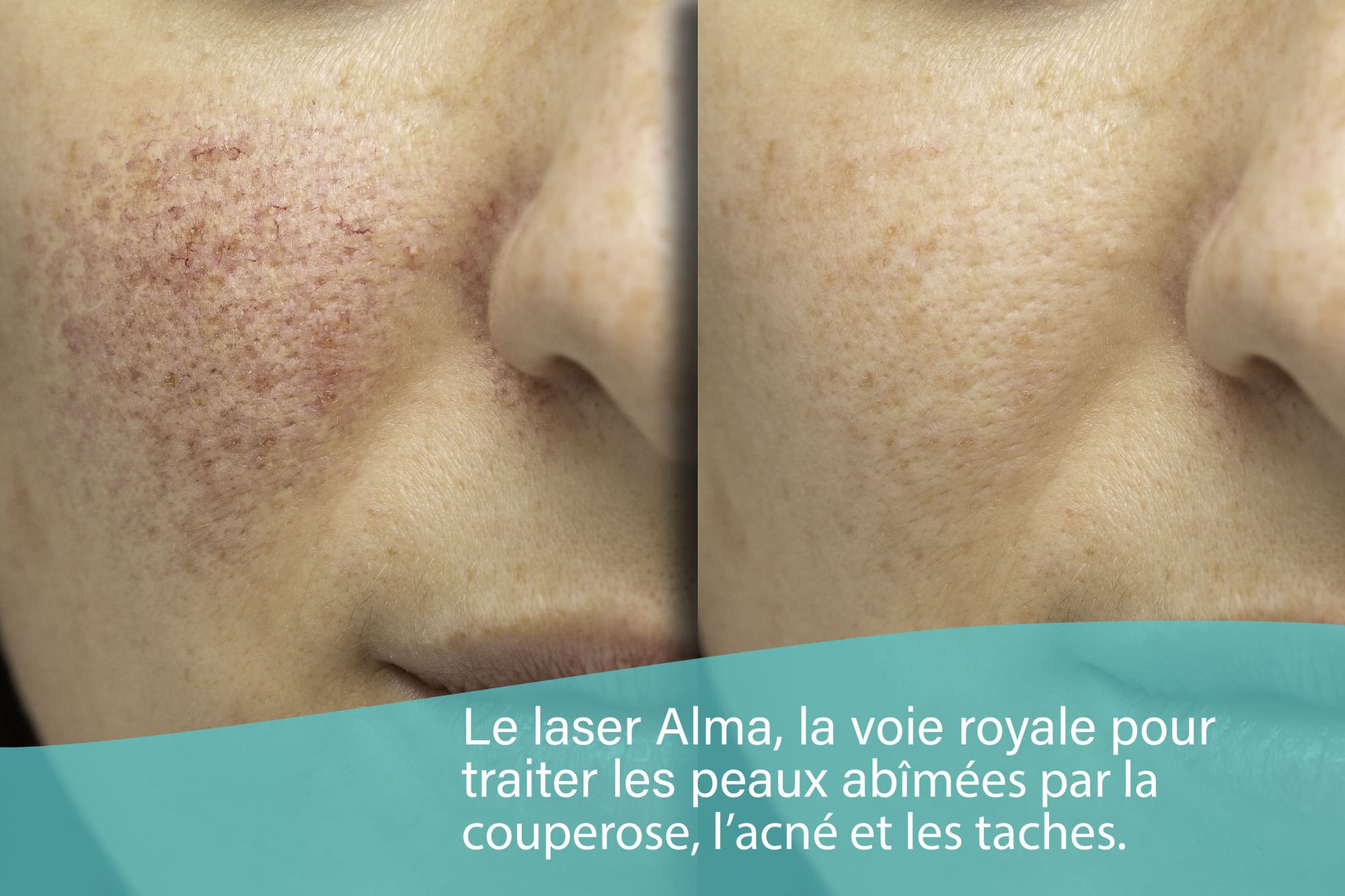 Couperose – Tâches pigmentaires – Acné